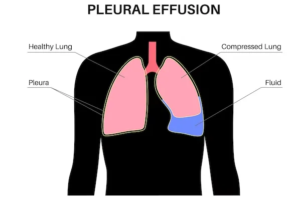 Pleural Effusion