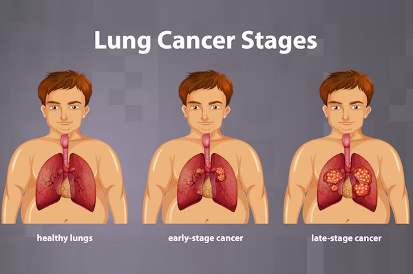 Lung Cancer