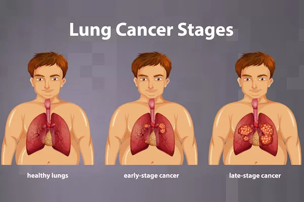 Lung Cancer